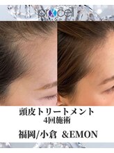 アンドエモン(&EMON)/【頭皮】プロセル効果