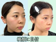 ナチュラルパーフェクトフェイス 新宿/整った横顔を新宿小顔専門店で