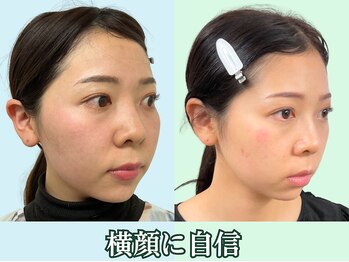 ナチュラルパーフェクトフェイス 新宿/整った横顔を新宿小顔専門店で