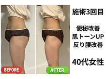 パラアモール(Paraamor)/フェムケア施術3回目