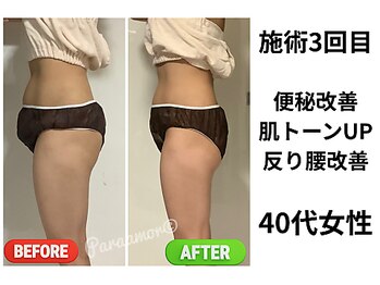 パラアモール(Paraamor)/フェムケア施術3回目