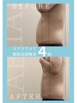 エアリアル 玉名店/脂肪冷却痩身