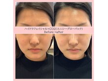 ディアメ(Diame)/くすみにはハイドラフェイシャル