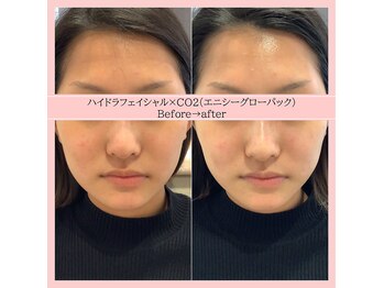ディアメ(Diame)/くすみにはハイドラフェイシャル