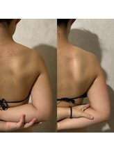 凰湖/ブライダルケア（1回での変化）