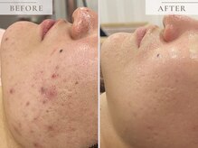 レヴィア(Revia)/ニキビケアにもハーブピーリング