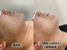 みんなのLED脱毛/男性・ひげ施術
