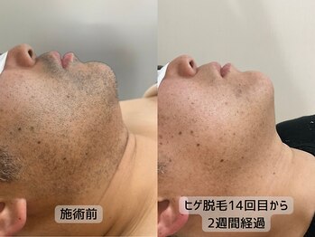 みんなのLED脱毛/男性・ひげ施術