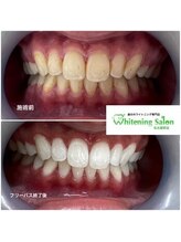 ホワイトニングサロン 名古屋駅店/【ホワイトニング施術例】