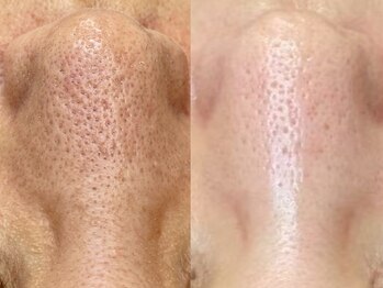 グラーティア 奈良王寺店の写真/【毛穴/黒ずみ/角栓】もう一人で悩まないで！毛穴に悩んでる人必見！