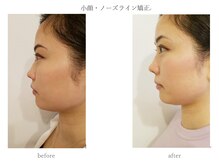 プラナ(PRANA)/小顔/頭蓋骨/ノーズライン矯正