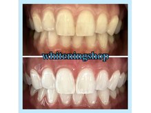 ホワイトニングショップ 天王寺店/10回ご来店後のお写真です