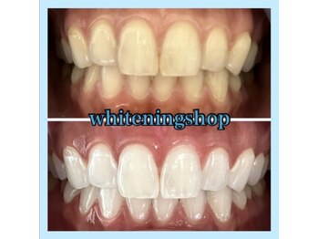 ホワイトニングショップ 天王寺店/10回ご来店後のお写真です