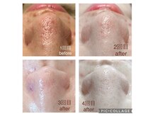 ミハナ(mihana)の雰囲気（毛穴改善コースのお客様）