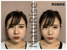 ナチュライズ(NatuRise)/リフトアップ、小顔に