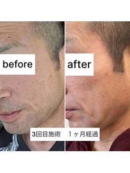 ラウラウ(laulau)/ヒゲ脱毛