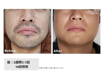 スプレール 水戸店/髭脱毛