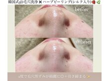 クレヴィー(Creviy)/韓国式3D毛穴洗浄×ハーブ1回