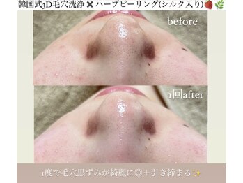 クレヴィー(Creviy)/韓国式3D毛穴洗浄×ハーブ1回