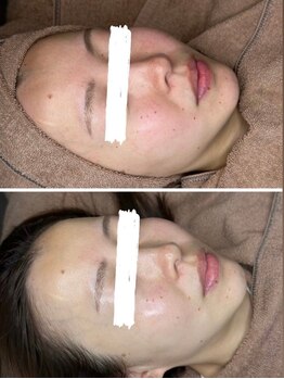 エクラルム(Eclaleum)/BeforeAfter　ララピール