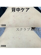 アルゴ 八幡黒崎店(ALGO)/背中ケア(スクラブx脱毛)