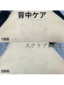 アルゴ 八幡黒崎店(ALGO)/背中ケア(スクラブx脱毛)