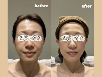 リタ 銀座(Rita)/花嫁美容◎ピーリング2ヶ月