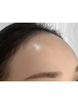 顔脱毛がしたい