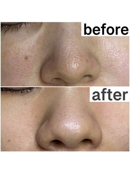 プルティティア(Pultitia)/毛穴洗浄