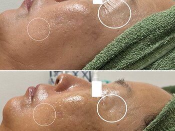 スローガーデン(Slow Garden)/ハーブピーリング×炭酸パック