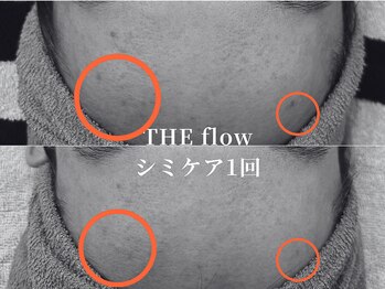 ザ フロウ(THE flow)/シミケア１回｜before/after