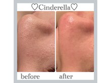 シンデレラ しみケア(Cinderella)/毛穴洗浄＋毛穴縮小マシーン