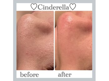 シンデレラ しみケア(Cinderella)/毛穴洗浄＋毛穴縮小マシーン