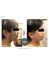 ダイアナ 出雲店(Daiana)/ヒゲ脱毛