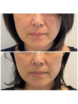 シーズボーテ(C's Beaute)/一回の施術でリフトUPは可能◎