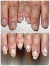 スマイルニコ(smile nico)/深爪矯正の中はこんな感じ