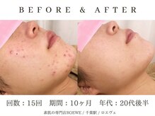 ロエヴェ(ROEWE)/ニキビ改善・毛穴ケア・肌質改善