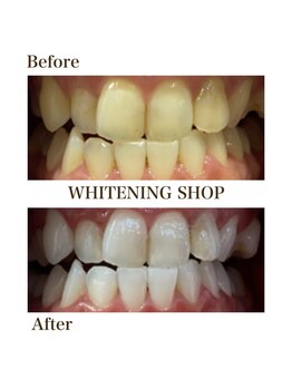 ホワイトニングショップ 一関店/9回照射後のbefore→after