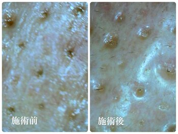 キーオブフェイス(Key of Face)/【鼻の毛穴詰まり・テカリ】