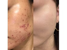 サロンドゥルシェル(salonde_le ciel)/肌の土台を入れ替えハーブリプロ