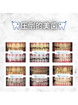 ホワイトニング モア(Whitening MORE)の写真/独自のオリジナルジェル使用で妊娠中の方にも♪痛みが少ない独自の美白ケアをWhitening MOREで体験しよう！