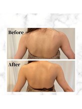 ザビューティー 麻布十番本店(The Beauty)/二の腕リフト打ち放題[リフト]