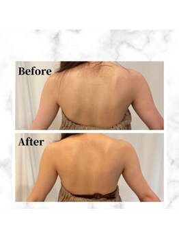 ザビューティー 麻布十番本店(The Beauty)/二の腕リフト打ち放題[リフト]