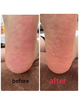 ホナ(HONA)/かかとケア