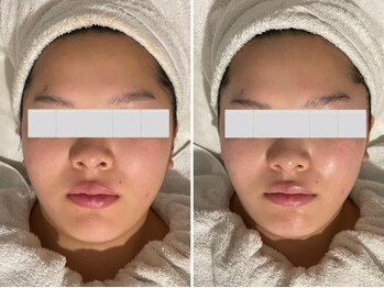 プライベートエステティックサロン クール(Coeur)/【小顔リフトアップコース】