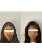 エスポワール(espoir) 最短リフト 小顔