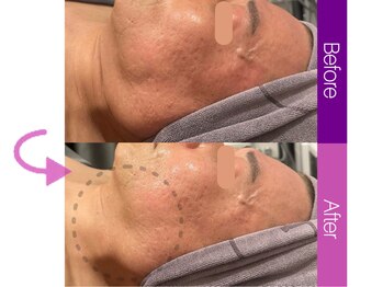 クレヴィア バイ サイバーエステ(CREBIA)/たるみケア【キャビテーション】