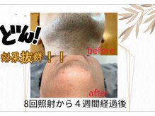 ルイース(LOUISE.)/脱毛