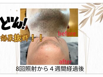 ルイース(LOUISE.)/脱毛