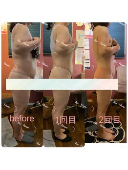 レイ 本厚木(Rei)/脂肪冷却のビフォーアフター